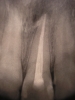 intraoralis-rtg-gyokertomes_s