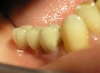 implant1_s