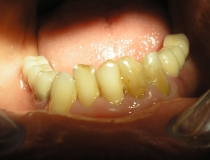 implant2