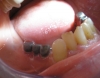 implant4_s